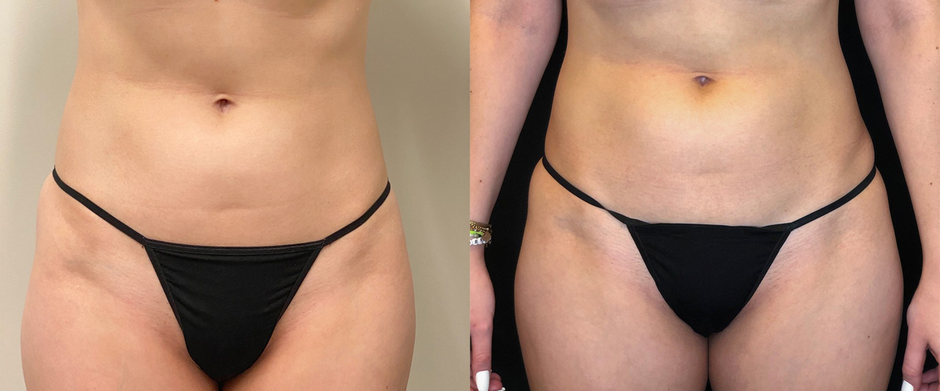 Can You See Results After One Emsculpt Session?