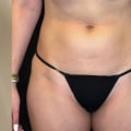 Can You Lose Weight with Emsculpt NEO?