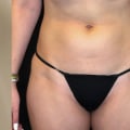 Maximizing Your Emsculpt NEO Results