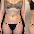 When Can You Expect to See Results from Emsculpt NEO?