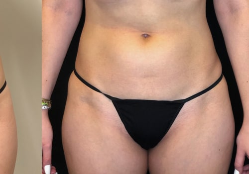 How Long After Emsculpt NEO Do You See Results?