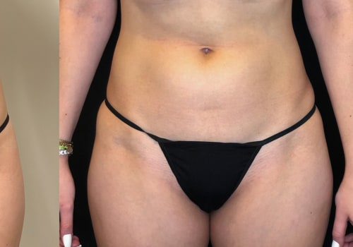 Can You Lose Weight with Emsculpt NEO?